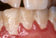 Οδοντική πλάκα πάνω στα δόντια