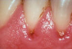 Gingivitis photo - Red swollen gums