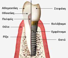 Οδοντικά Εμφυτεύματα