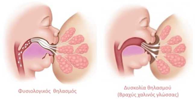 Βραχύς Χαλινός Γλώσσας Θηλασμός