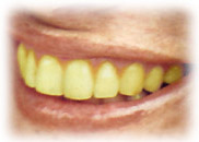 Κίτρινα δόντια